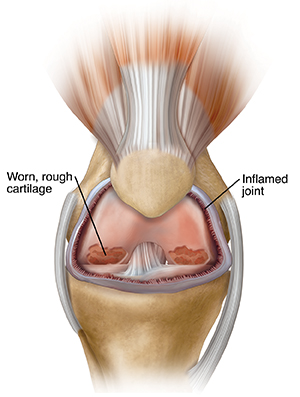 Front view of knee with arthritis.