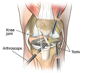 Front view of knee joint with arthroscope and instruments inserted.