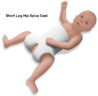 Illustration of child wearing a short leg hip spica cast
