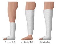 Illustrations of leg casts, 3 types