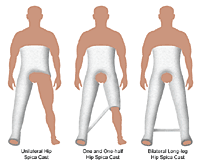 Illustrations of hip spica casts, 3 types